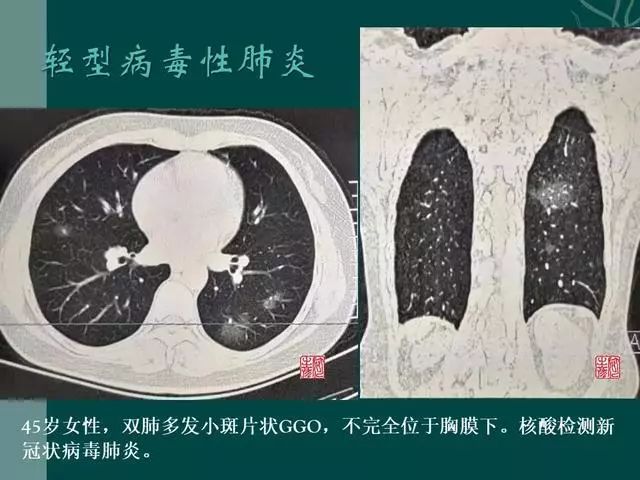 【PPT】病毒性肺炎概念与CT表现—新型冠状病毒肺炎