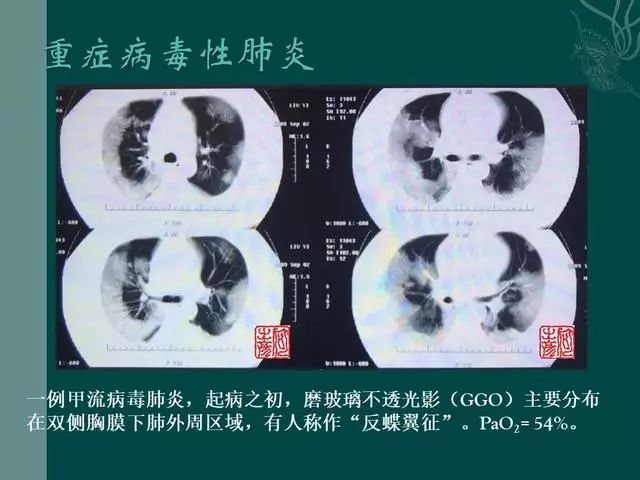 【PPT】病毒性肺炎概念与CT表现—新型冠状病毒肺炎