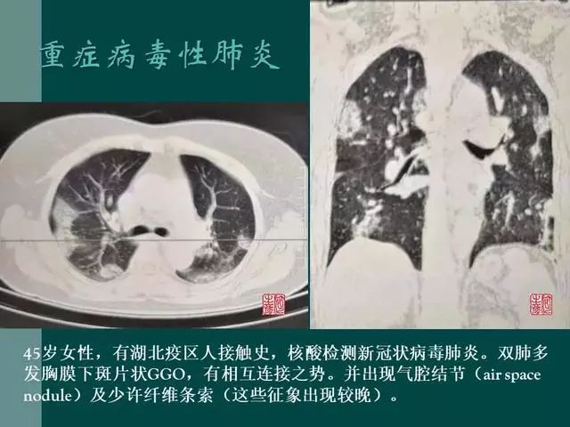 【PPT】病毒性肺炎概念与CT表现—新型冠状病毒肺炎