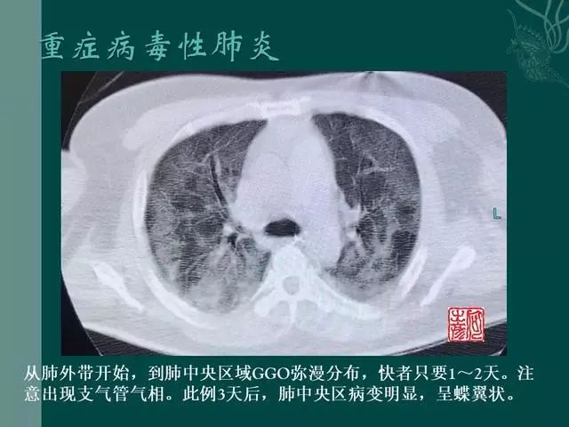 【PPT】病毒性肺炎概念与CT表现—新型冠状病毒肺炎