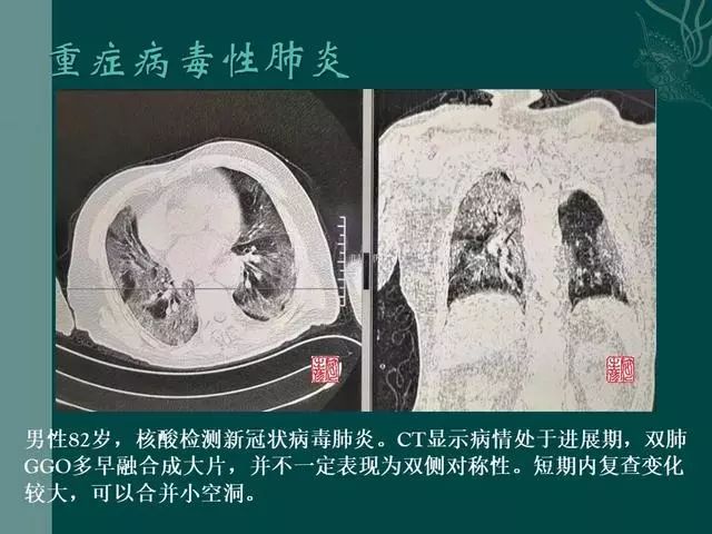 【PPT】病毒性肺炎概念与CT表现—新型冠状病毒肺炎
