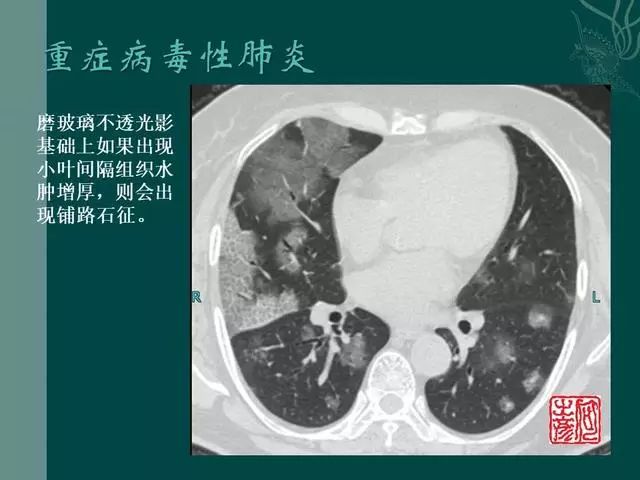 【PPT】病毒性肺炎概念与CT表现—新型冠状病毒肺炎