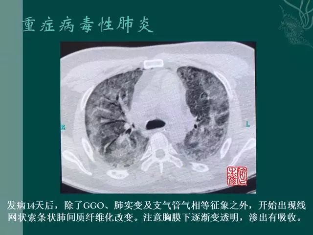 【PPT】病毒性肺炎概念与CT表现—新型冠状病毒肺炎
