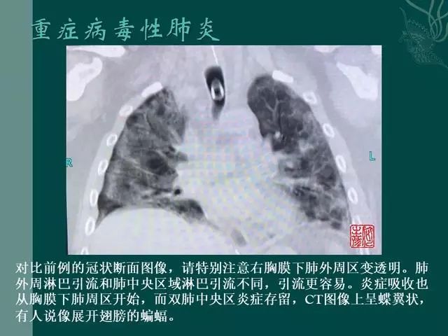 【PPT】病毒性肺炎概念与CT表现—新型冠状病毒肺炎