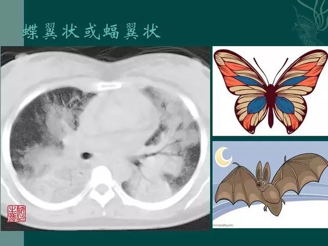 【PPT】病毒性肺炎概念与CT表现—新型冠状病毒肺炎