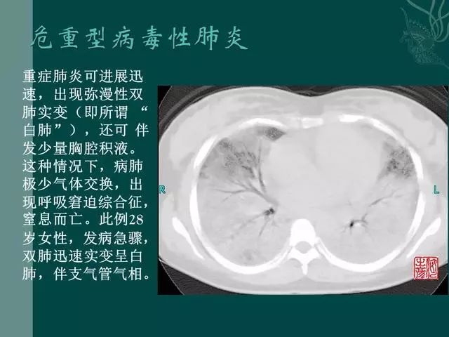 【PPT】病毒性肺炎概念与CT表现—新型冠状病毒肺炎