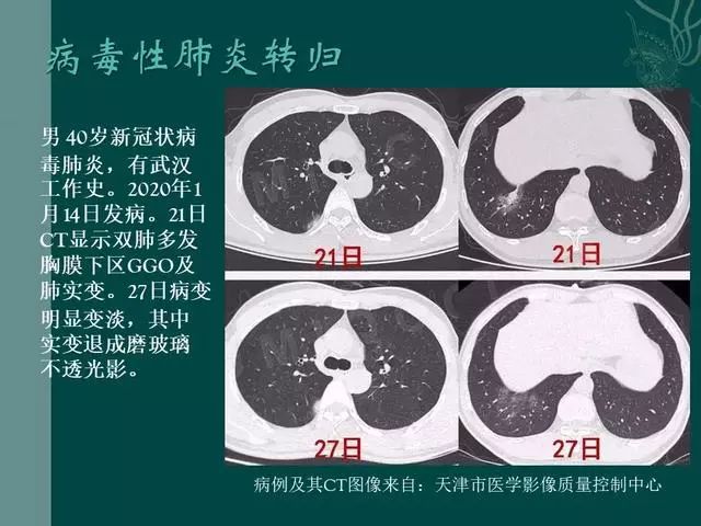 【PPT】病毒性肺炎概念与CT表现—新型冠状病毒肺炎
