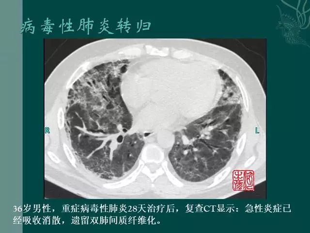 【PPT】病毒性肺炎概念与CT表现—新型冠状病毒肺炎