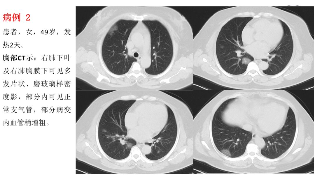 【PPT】20例新型冠状病毒肺炎的CT表现汇总