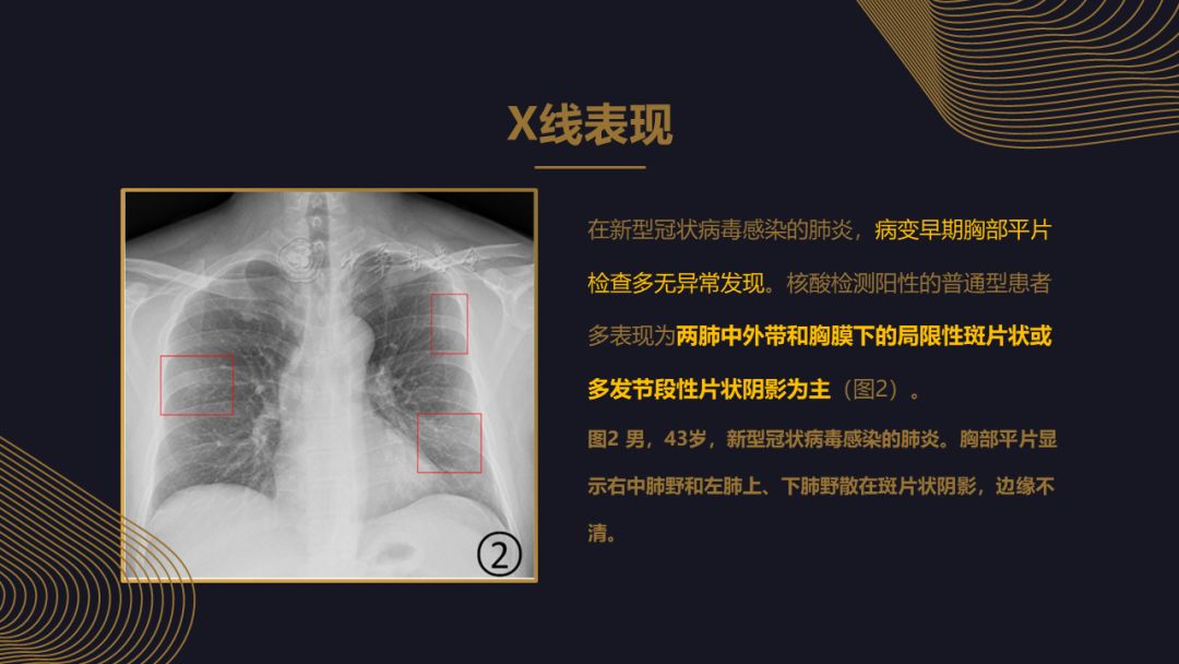 【PPT】新冠肺炎的放射学诊断：中华医学会放射学分会专家推荐意见第一版