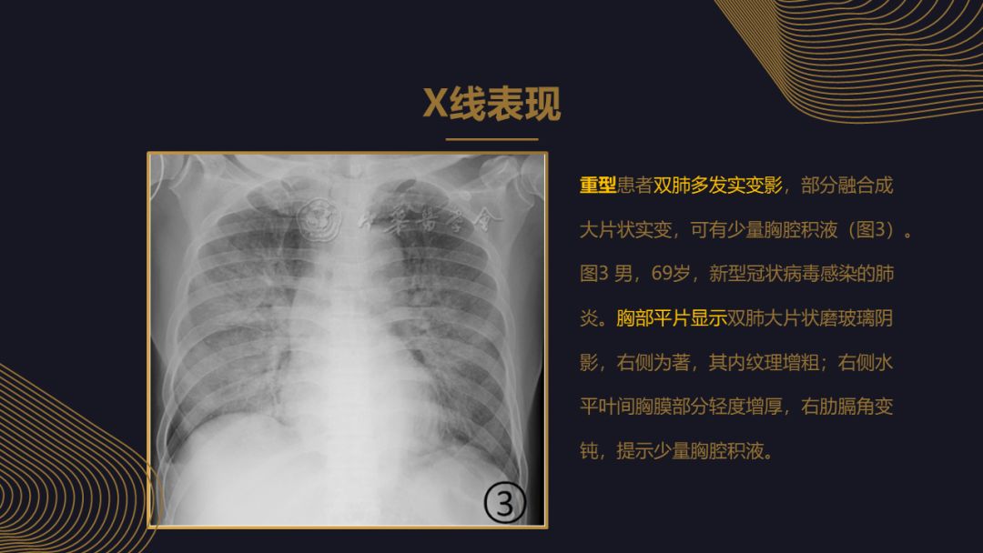 【PPT】新冠肺炎的放射学诊断：中华医学会放射学分会专家推荐意见第一版