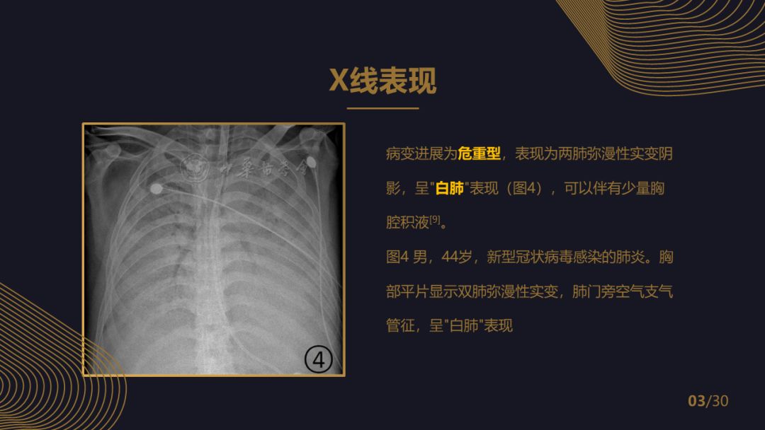 【PPT】新冠肺炎的放射学诊断：中华医学会放射学分会专家推荐意见第一版