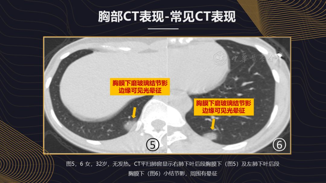 【PPT】新冠肺炎的放射学诊断：中华医学会放射学分会专家推荐意见第一版