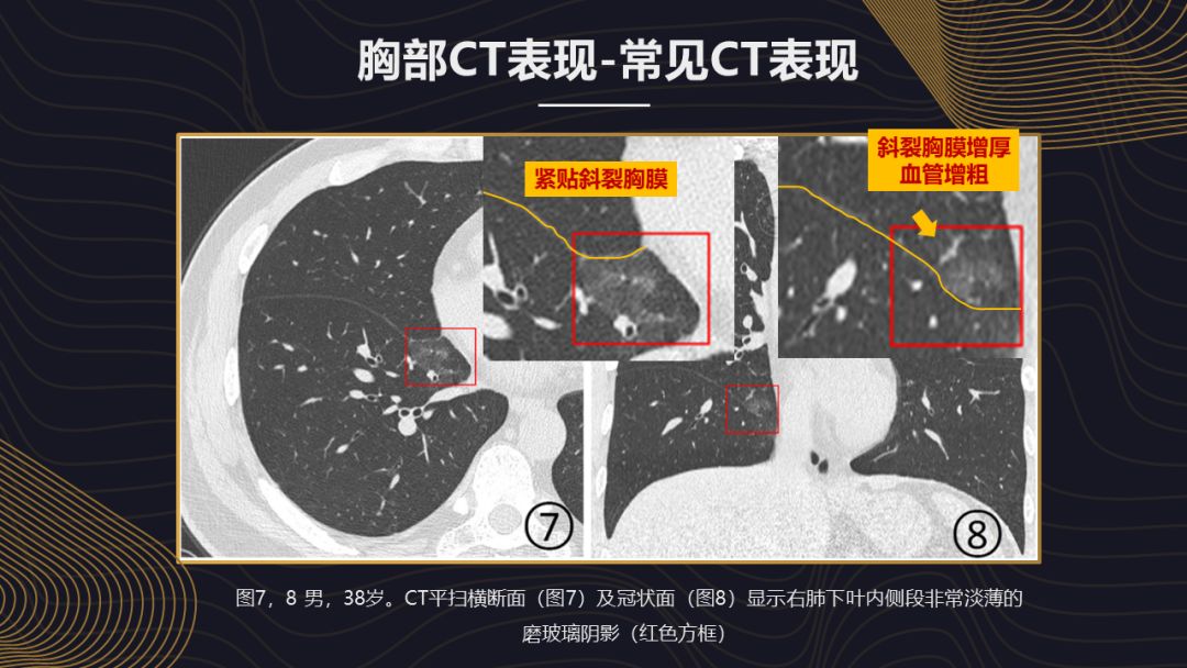 【PPT】新冠肺炎的放射学诊断：中华医学会放射学分会专家推荐意见第一版