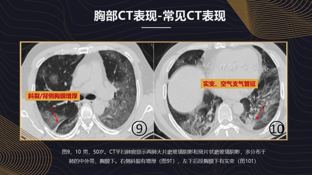 【PPT】新冠肺炎的放射学诊断：中华医学会放射学分会专家推荐意见第一版
