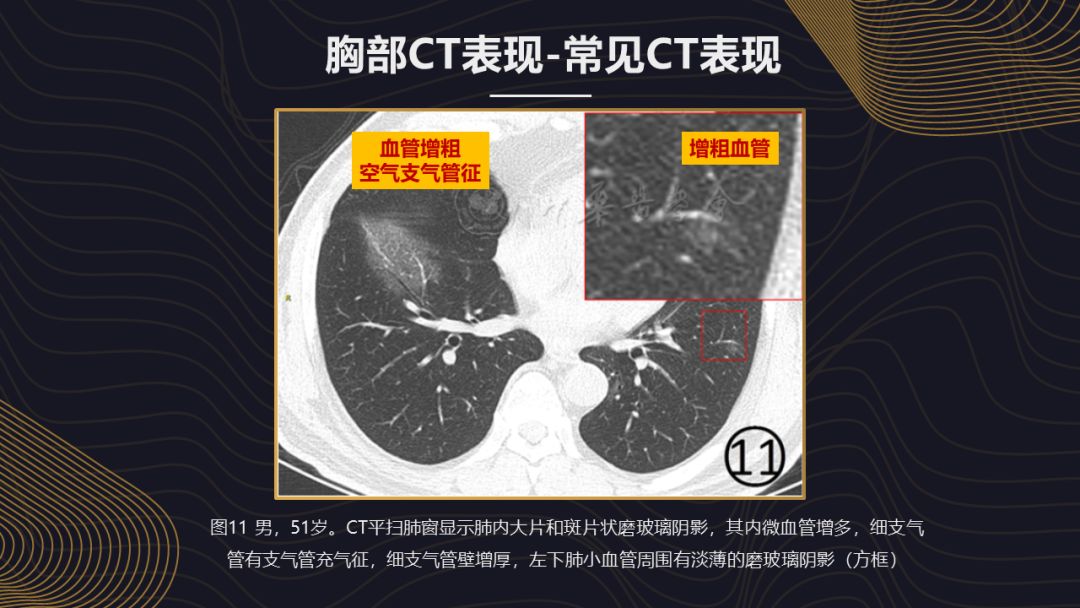 【PPT】新冠肺炎的放射学诊断：中华医学会放射学分会专家推荐意见第一版