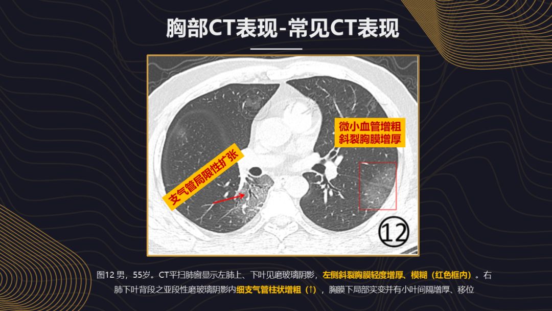【PPT】新冠肺炎的放射学诊断：中华医学会放射学分会专家推荐意见第一版