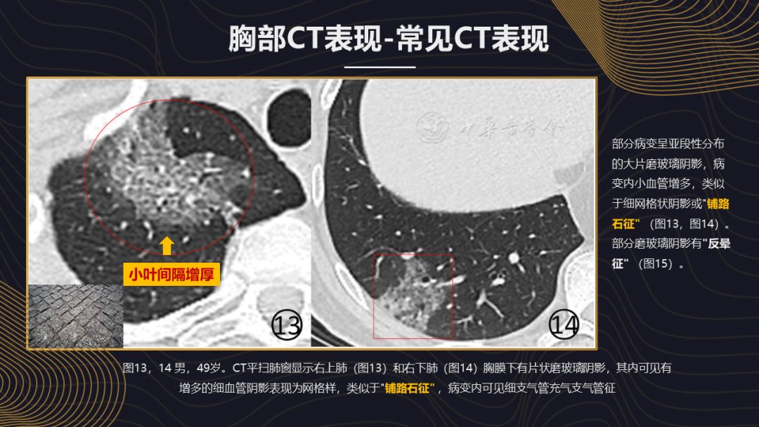 【PPT】新冠肺炎的放射学诊断：中华医学会放射学分会专家推荐意见第一版