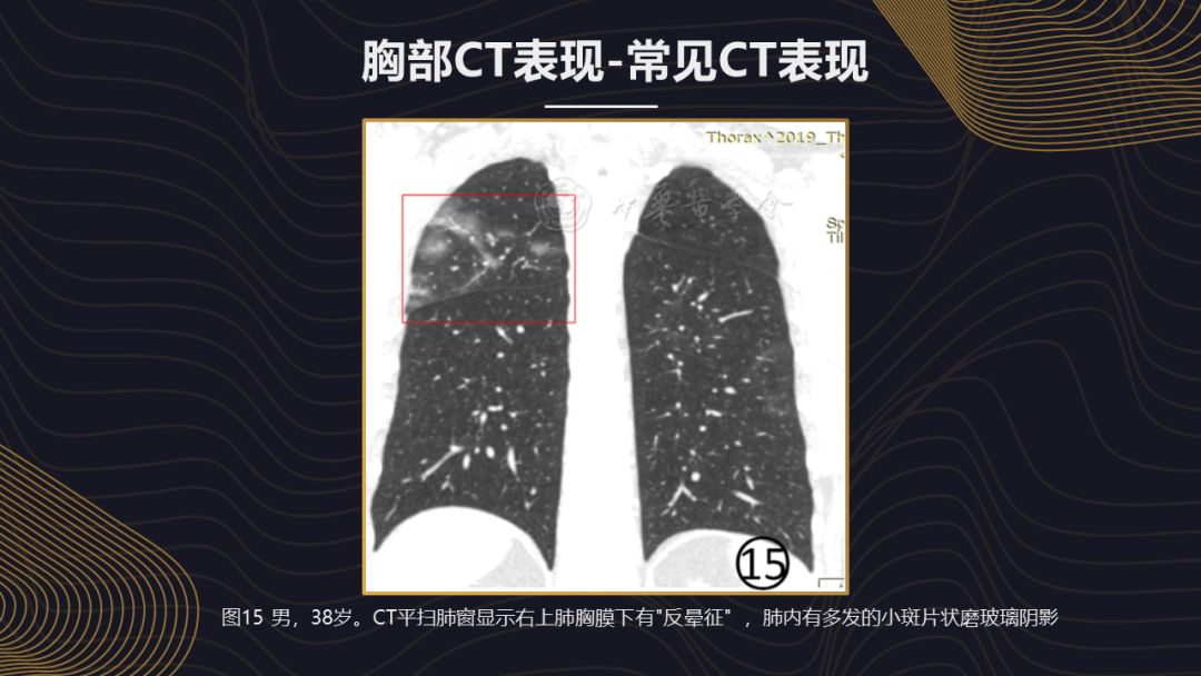【PPT】新冠肺炎的放射学诊断：中华医学会放射学分会专家推荐意见第一版