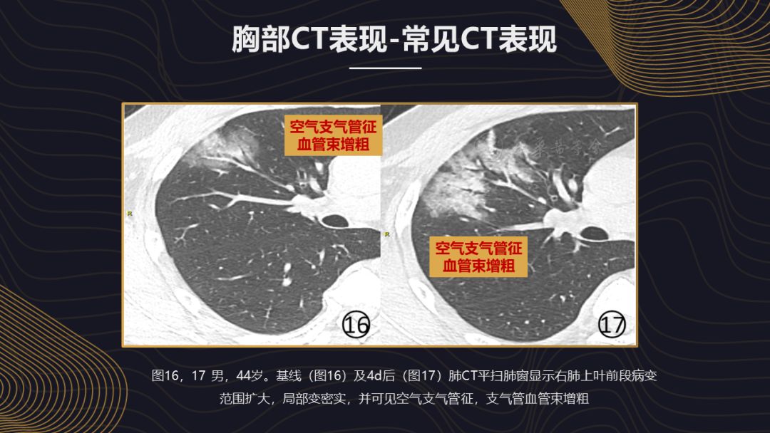【PPT】新冠肺炎的放射学诊断：中华医学会放射学分会专家推荐意见第一版