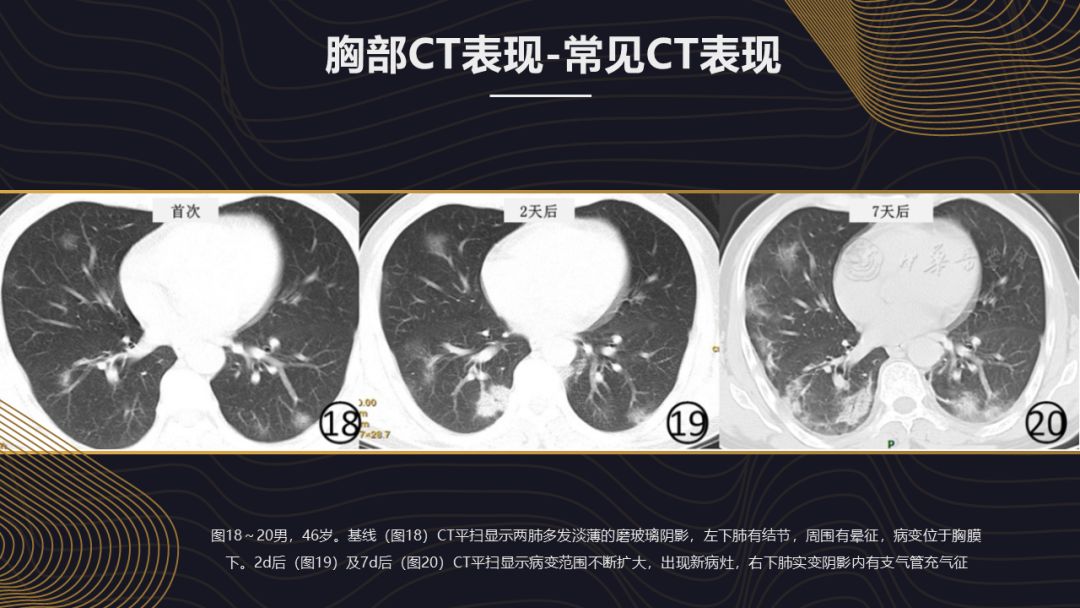 【PPT】新冠肺炎的放射学诊断：中华医学会放射学分会专家推荐意见第一版