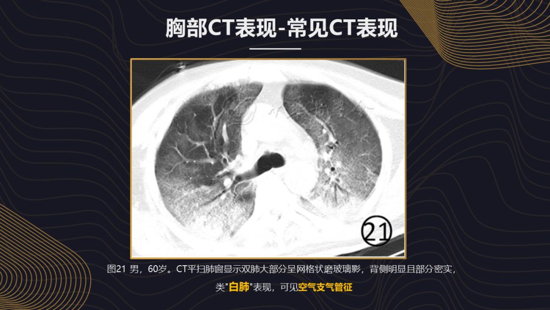 【PPT】新冠肺炎的放射学诊断：中华医学会放射学分会专家推荐意见第一版