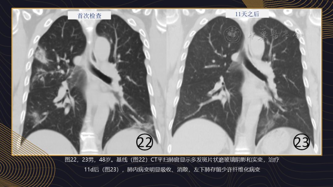 【PPT】新冠肺炎的放射学诊断：中华医学会放射学分会专家推荐意见第一版