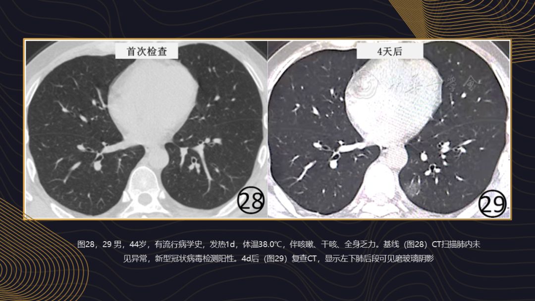 【PPT】新冠肺炎的放射学诊断：中华医学会放射学分会专家推荐意见第一版