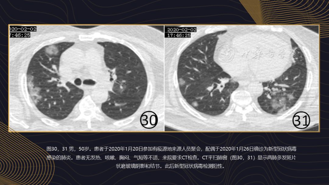 【PPT】新冠肺炎的放射学诊断：中华医学会放射学分会专家推荐意见第一版
