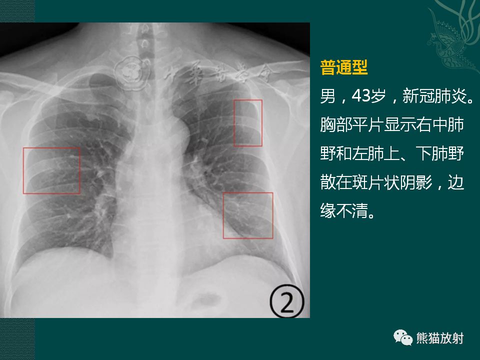 【PPT】新型冠状病毒肺炎的放射学诊断：中放专家推荐意见