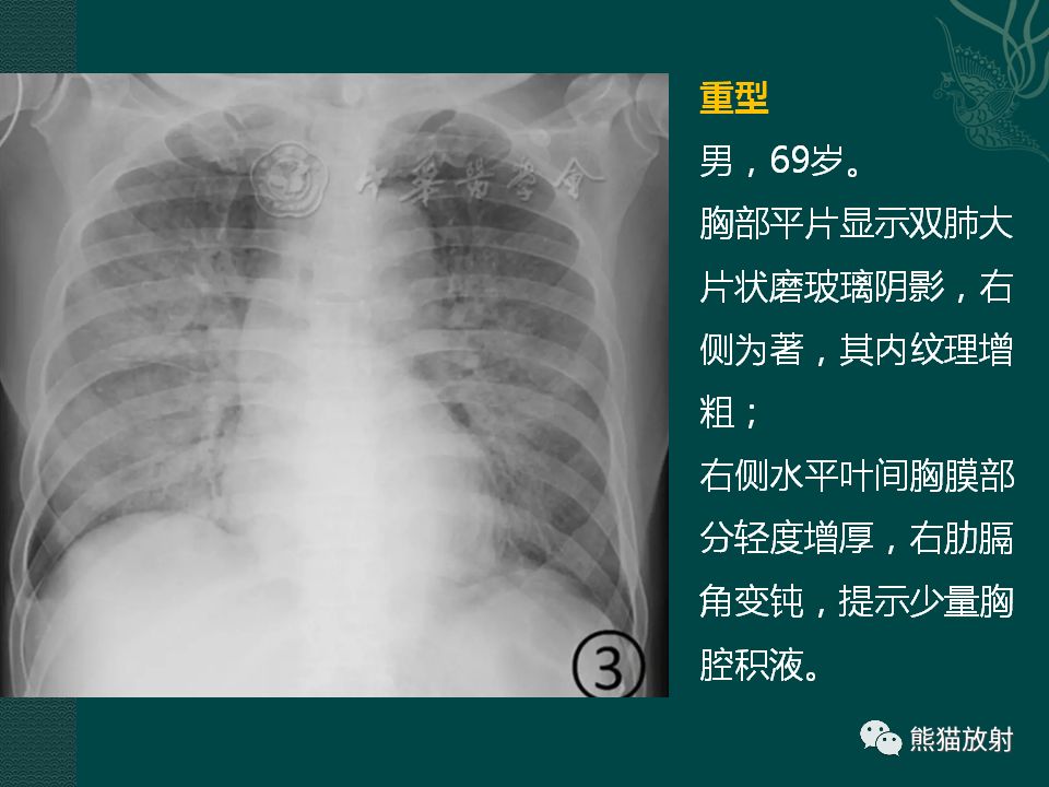【PPT】新型冠状病毒肺炎的放射学诊断：中放专家推荐意见