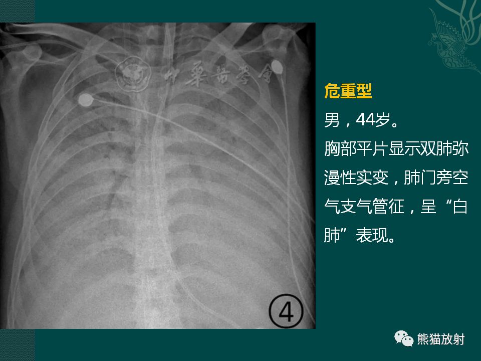 【PPT】新型冠状病毒肺炎的放射学诊断：中放专家推荐意见
