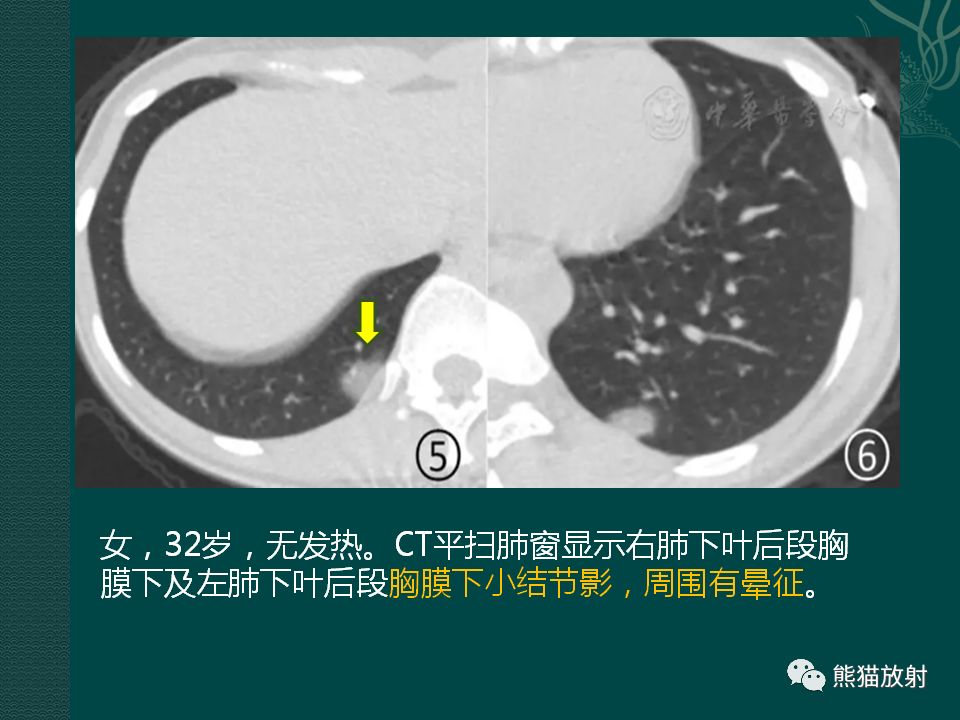 【PPT】新型冠状病毒肺炎的放射学诊断：中放专家推荐意见