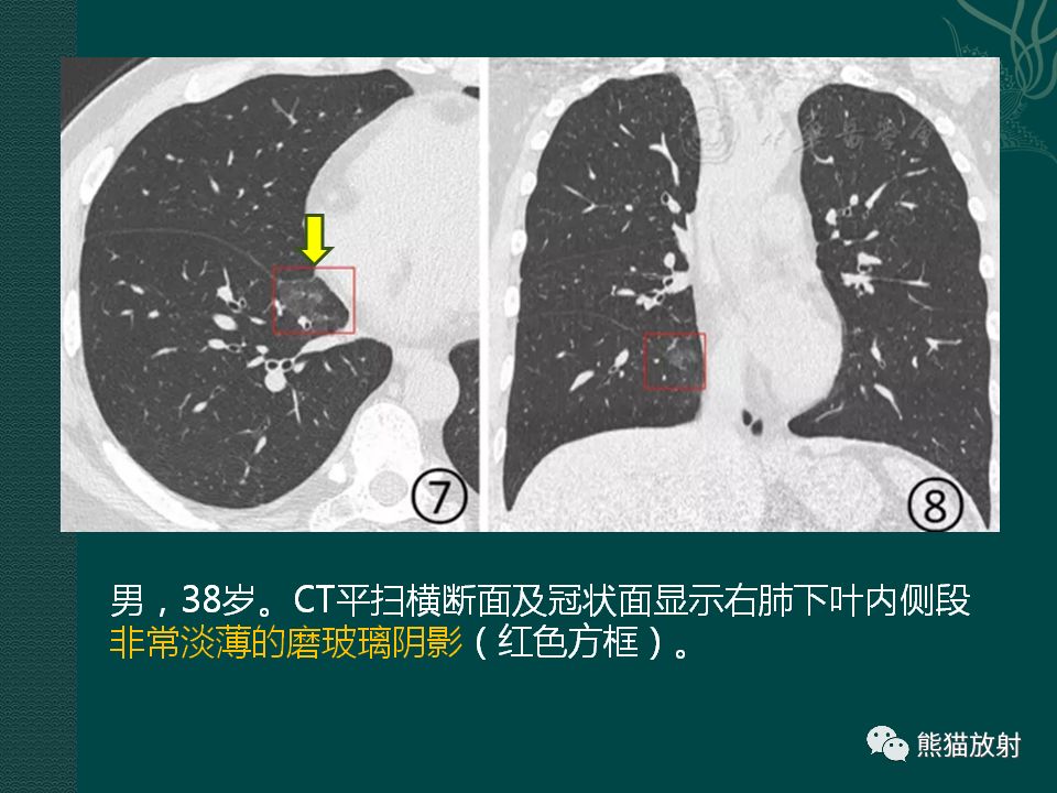 【PPT】新型冠状病毒肺炎的放射学诊断：中放专家推荐意见