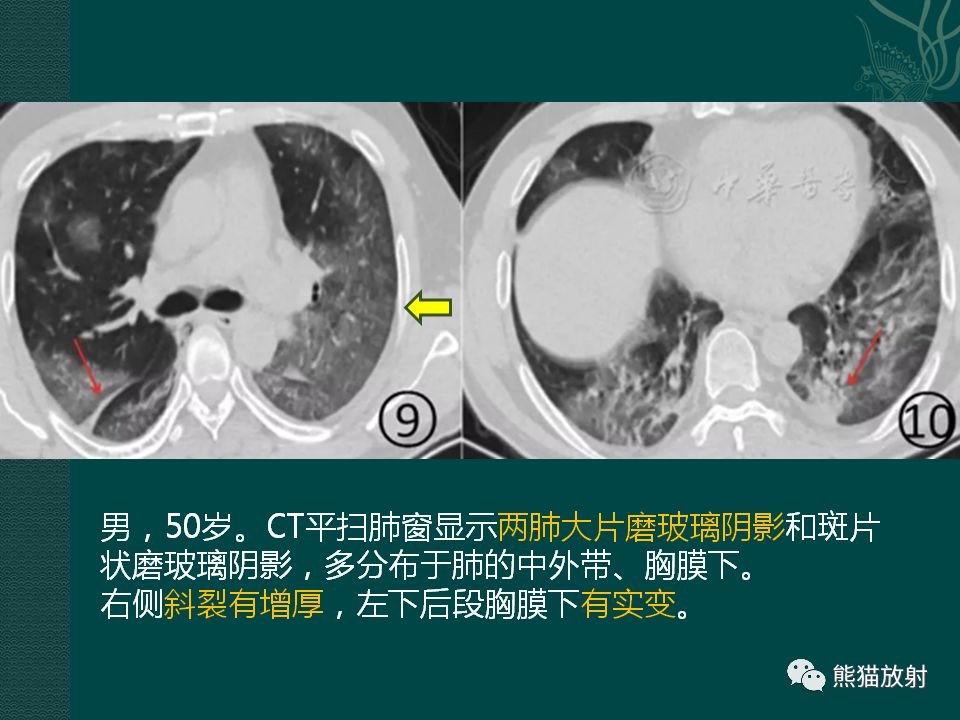 【PPT】新型冠状病毒肺炎的放射学诊断：中放专家推荐意见