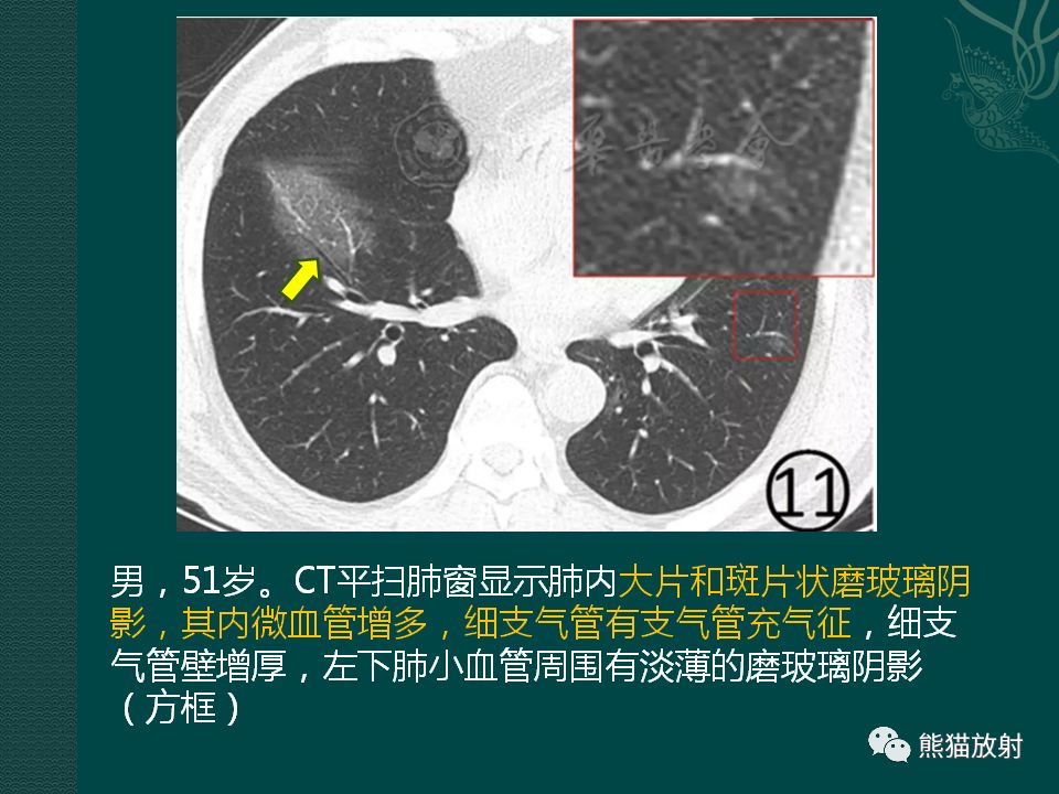 【PPT】新型冠状病毒肺炎的放射学诊断：中放专家推荐意见