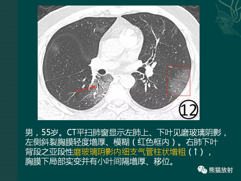 【PPT】新型冠状病毒肺炎的放射学诊断：中放专家推荐意见