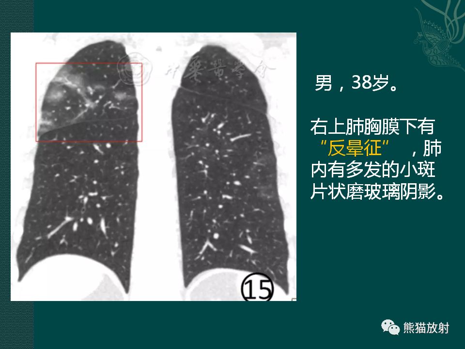 【PPT】新型冠状病毒肺炎的放射学诊断：中放专家推荐意见