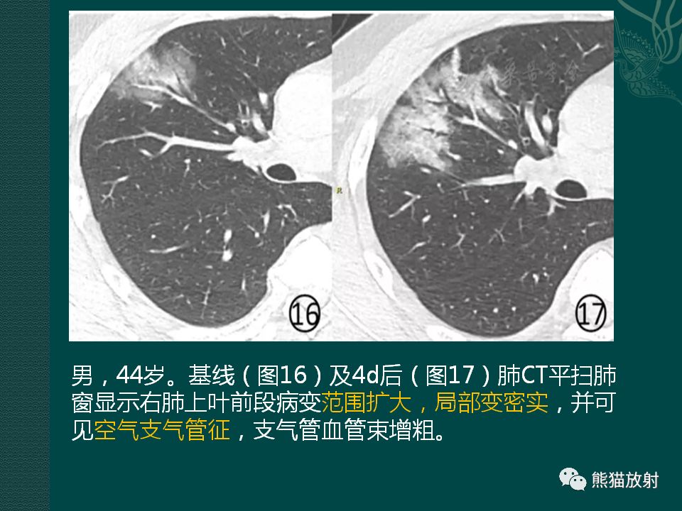 【PPT】新型冠状病毒肺炎的放射学诊断：中放专家推荐意见
