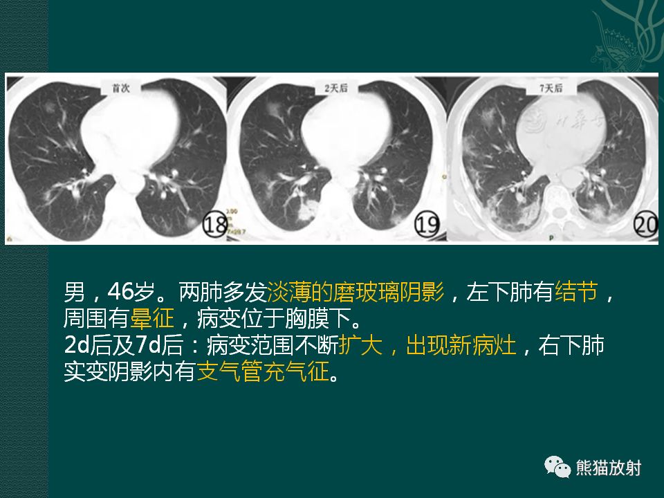 【PPT】新型冠状病毒肺炎的放射学诊断：中放专家推荐意见