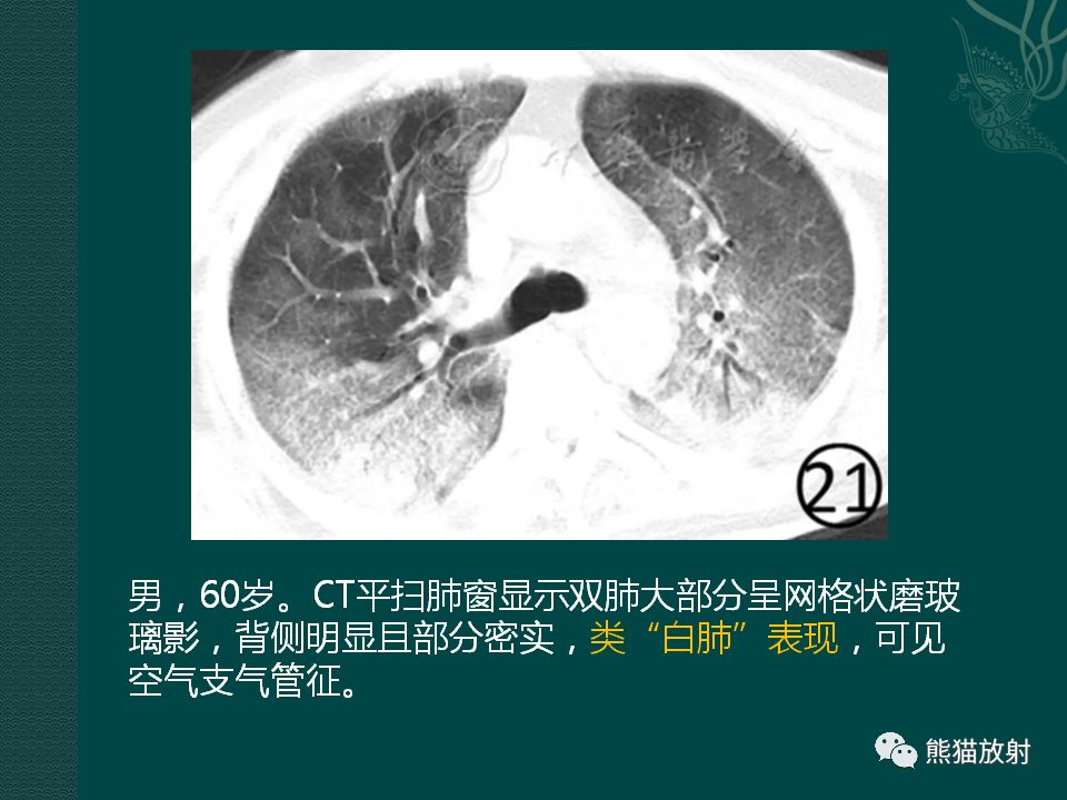 【PPT】新型冠状病毒肺炎的放射学诊断：中放专家推荐意见