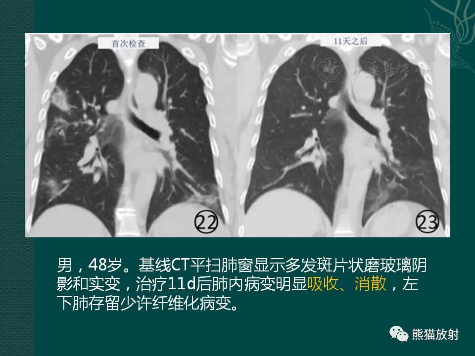 【PPT】新型冠状病毒肺炎的放射学诊断：中放专家推荐意见
