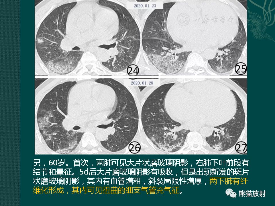 【PPT】新型冠状病毒肺炎的放射学诊断：中放专家推荐意见