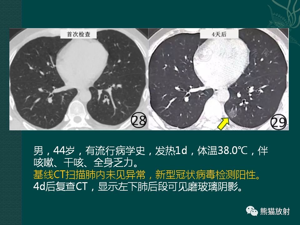 【PPT】新型冠状病毒肺炎的放射学诊断：中放专家推荐意见