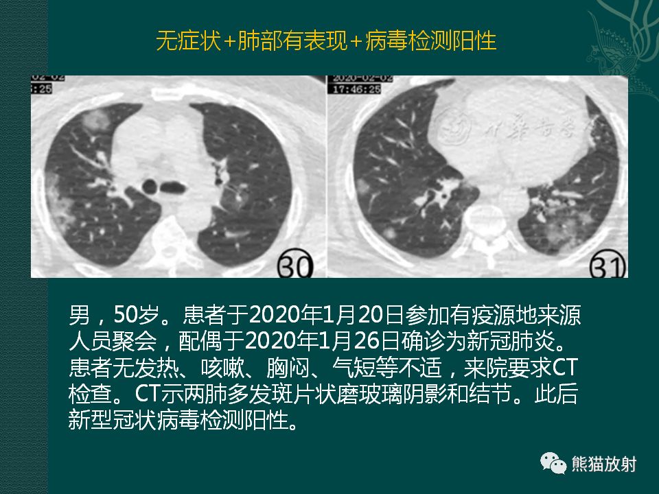 【PPT】新型冠状病毒肺炎的放射学诊断：中放专家推荐意见