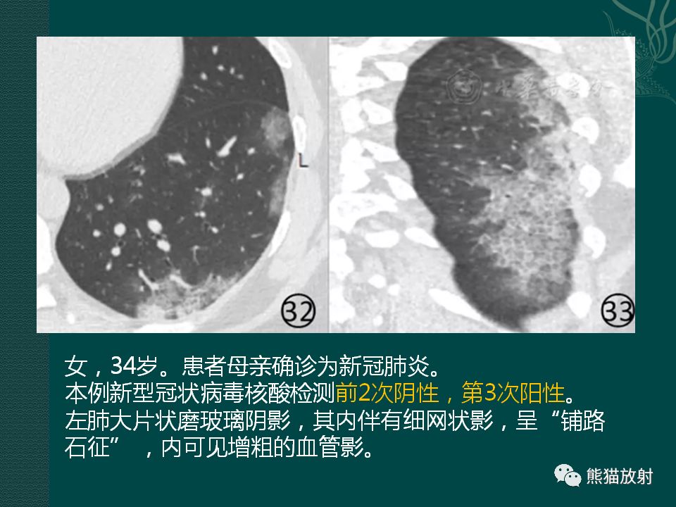 【PPT】新型冠状病毒肺炎的放射学诊断：中放专家推荐意见