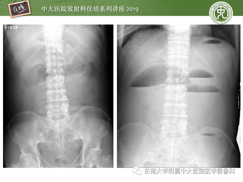 【PPT】小肠梗阻的影像分析及诊断