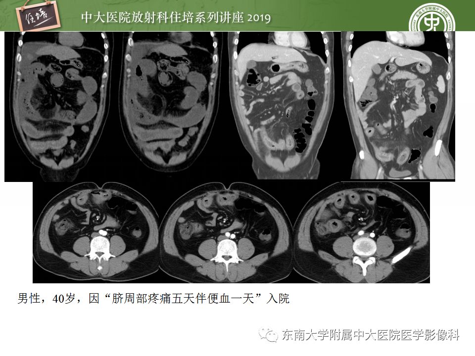 【PPT】小肠梗阻的影像分析及诊断