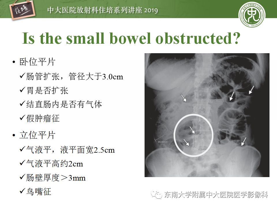 【PPT】小肠梗阻的影像分析及诊断