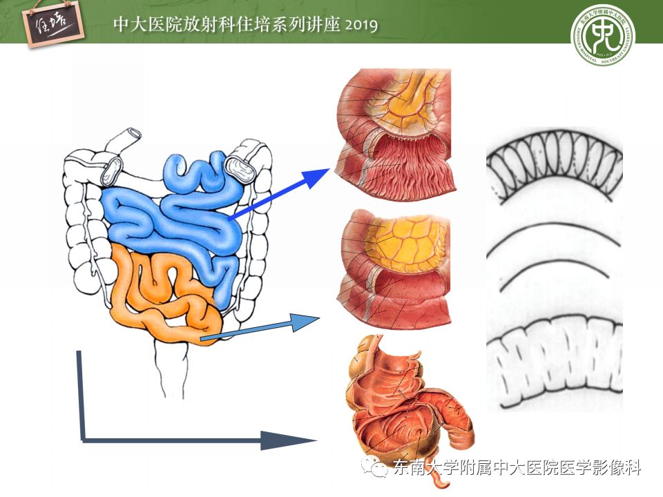 【PPT】小肠梗阻的影像分析及诊断